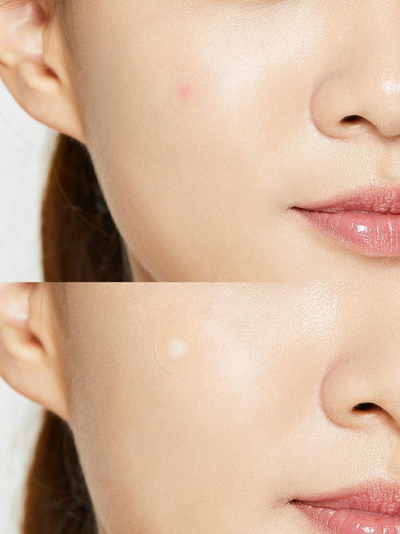 COSRX Acne Pimple Master 24 Patches – Hydrocolloid Spot Treatment for Rapid Acne Healing and Blemish Care